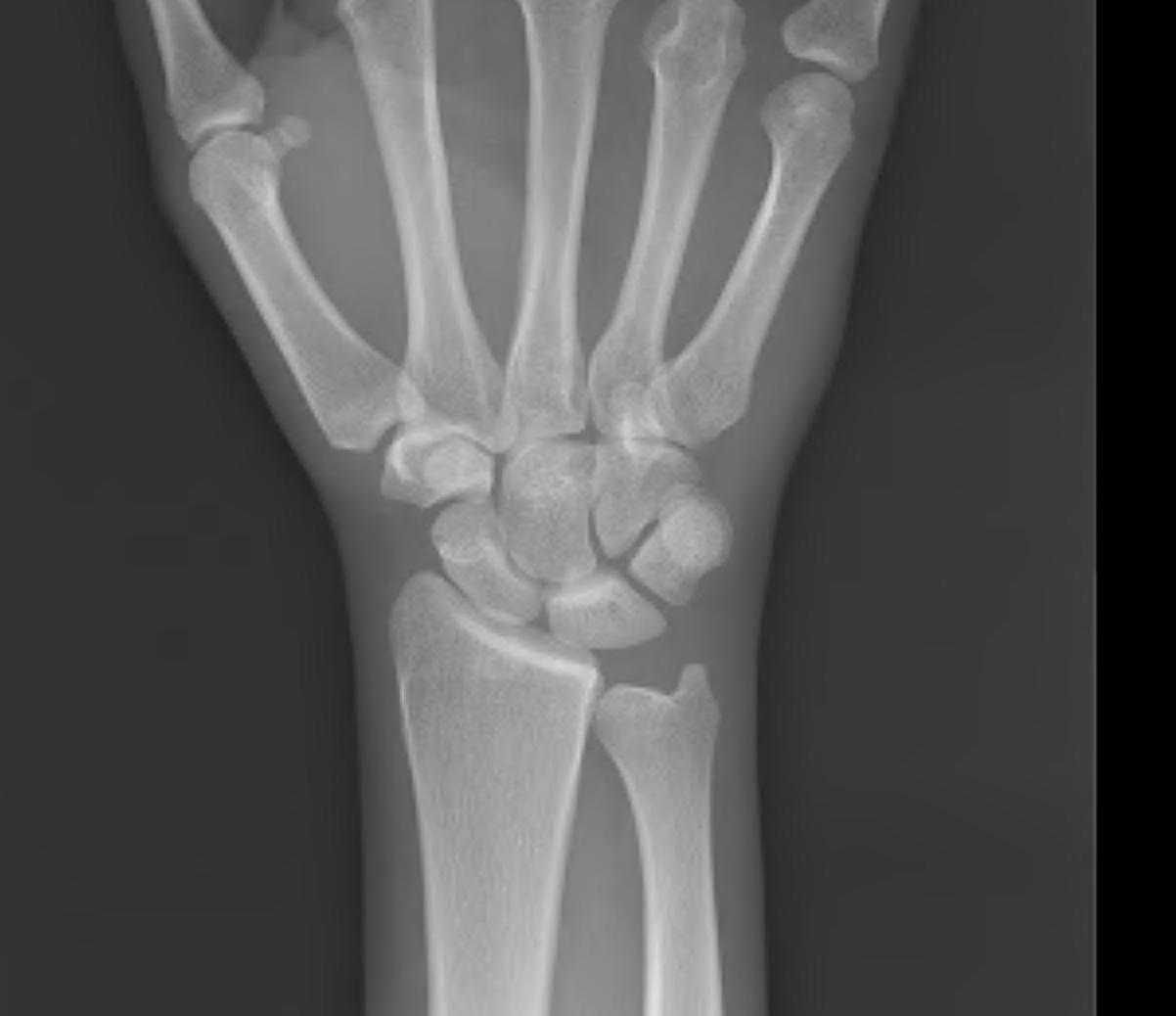 Ulna Negative